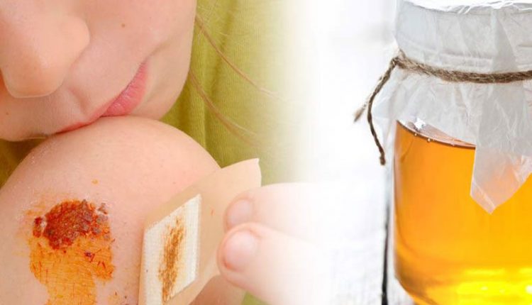 3 کاربرد عسل در درمان زخم های مهم|درمان زخم با عسل