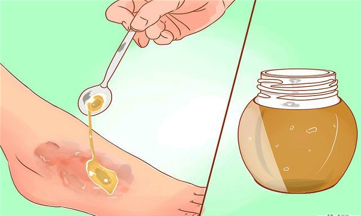 کاربرد عسل در درمان زخم